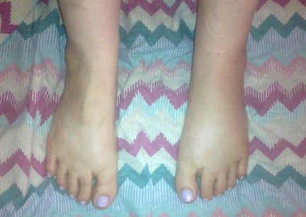 Marna's Foot Injury 2014-08-20